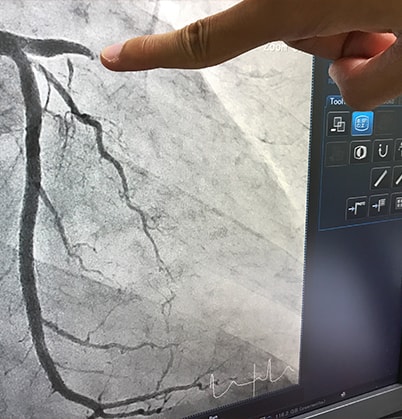 Coronary angiogram